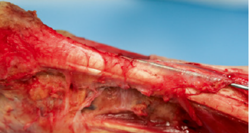 Tendinopathie pardon?